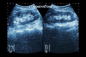 Kidney Stone Diagnosis