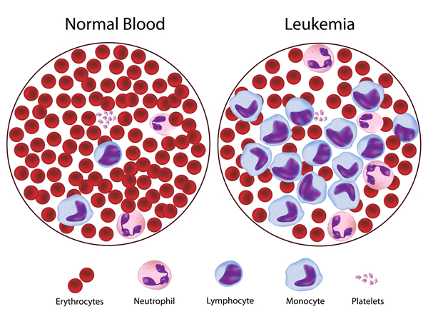 Leukemia Causes