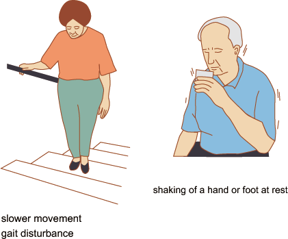 Parkinsons Disease Symptoms