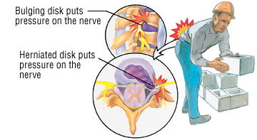 Back Pain