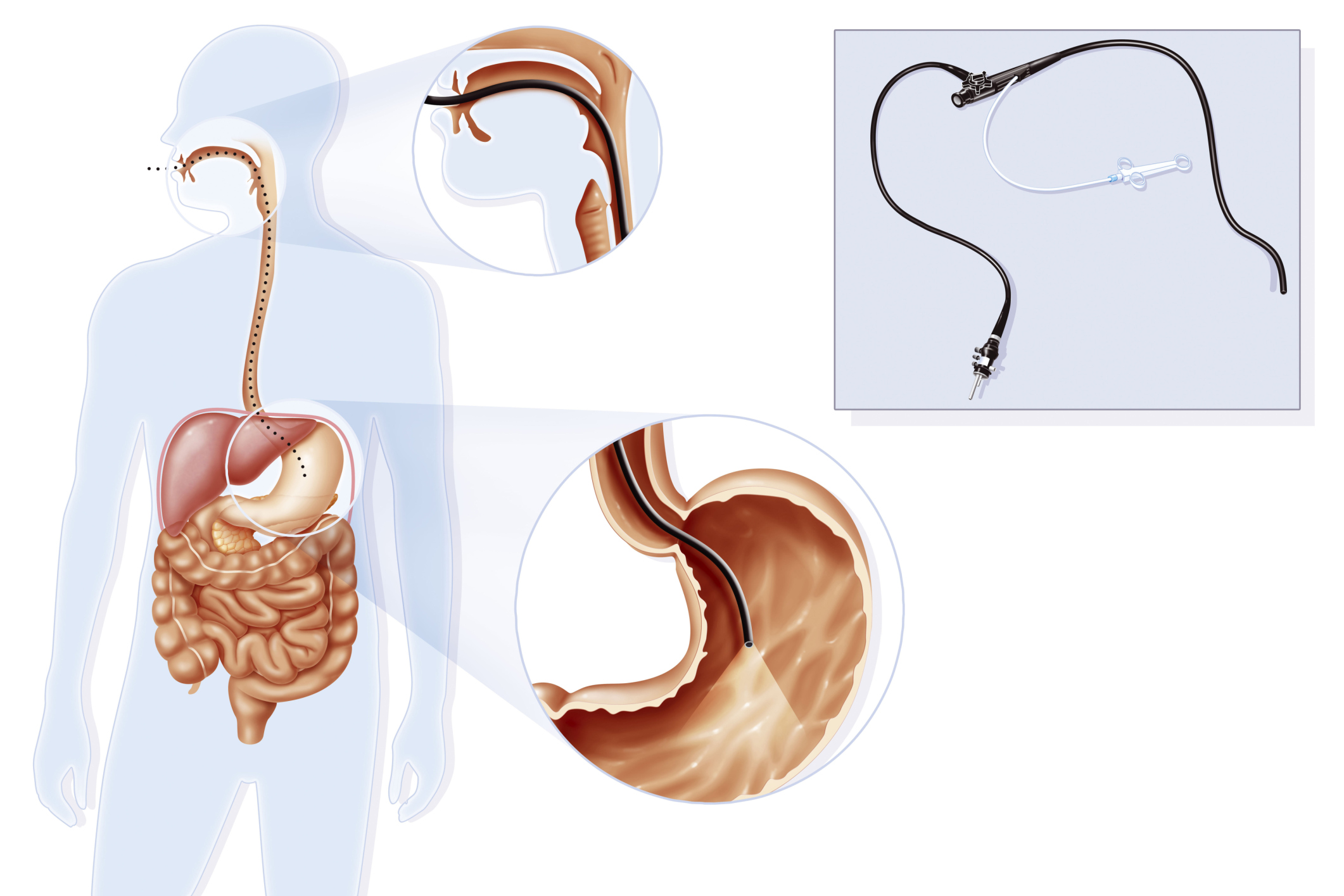 Acid Reflux Diagnosis