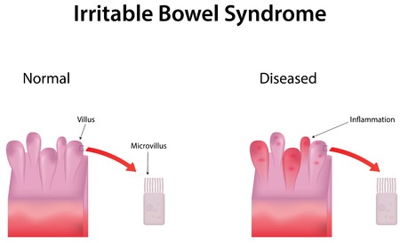 Irritable Bowel Syndrome Causes