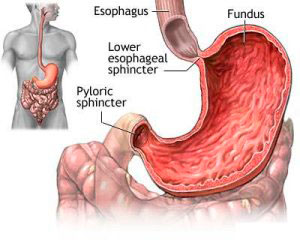 What is Acid Reflux?