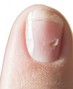 Brittle Nails