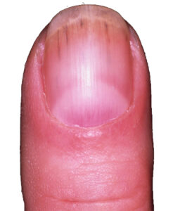 Discolored nails