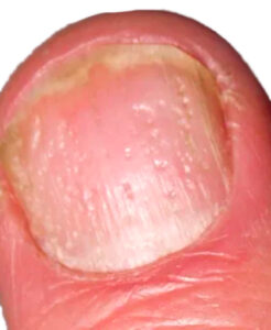 Pitted Nails