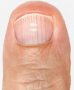 White Spots on Nail