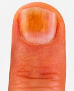 Yellow Nails