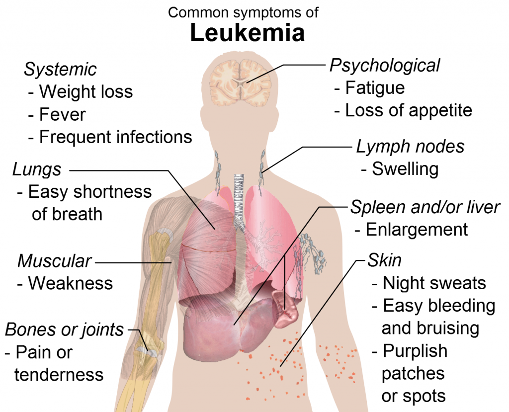 Leukemia Symptoms