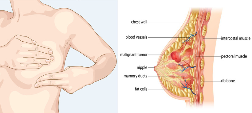 Signs and Symptoms of Breast Cancer